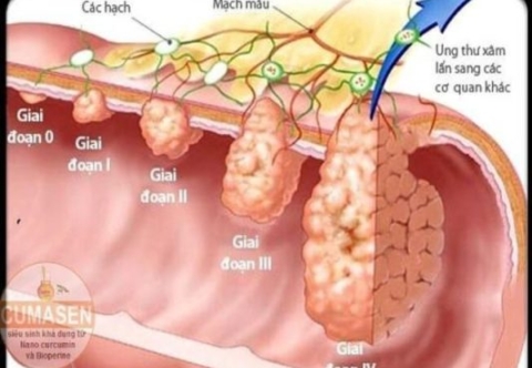 Phân loại ung thư trực tràng?