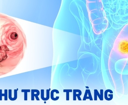 Vì sao ung thư trực tràng lại dễ tái phát