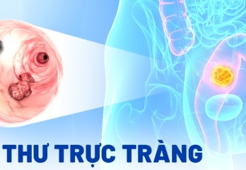Vì sao ung thư trực tràng lại dễ tái phát