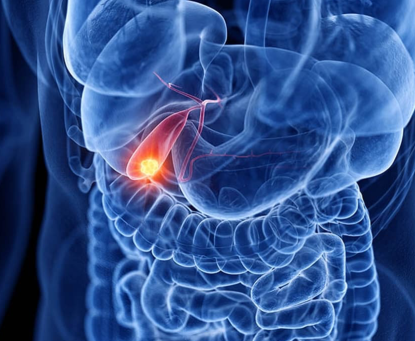 Béo phì và nguy cơ ung thư túi mật