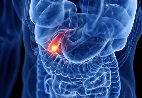 Béo phì và nguy cơ ung thư túi mật