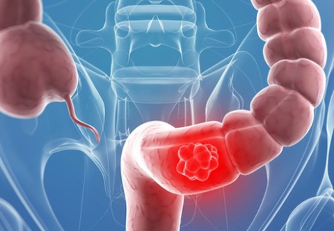 Phẫu thuật ung thư đại trực tràng được thực hiện thế nào, có biến chứng gì không?