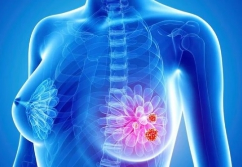 Công nghệ AI dự đoán nguy cơ ung thư vú từ các tế bào