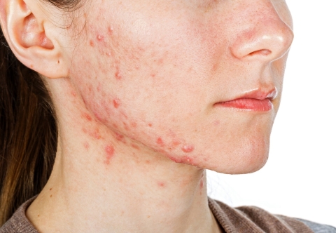 Vì sao táo bón kéo dài gây các bệnh lý về da?