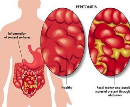 Hướng dẫn chăm sóc sau mổ viêm phúc mạc