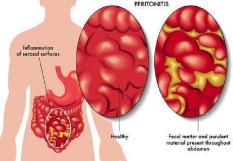 Hướng dẫn chăm sóc sau mổ viêm phúc mạc