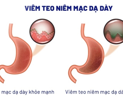 Viêm teo niêm mạc dạ dày và mối liên quan với ung thư dạ dày