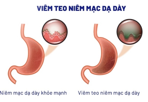 Viêm teo niêm mạc dạ dày và mối liên quan với ung thư dạ dày