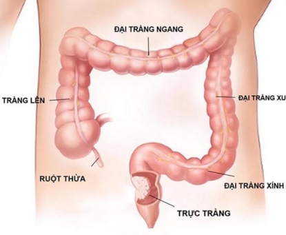 Phòng ngừa viêm loét trực tràng gây ung thư trực tràng