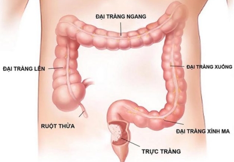 Phòng ngừa viêm loét trực tràng gây ung thư trực tràng