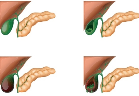 Dấu hiệu sớm của viêm túi mật cấp là gì?