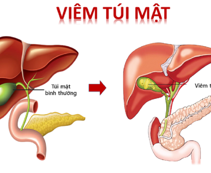 Dấu hiệu cảnh báo bệnh viêm túi mật cấp do sỏi túi mật
