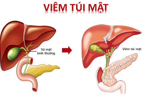 Dấu hiệu cảnh báo bệnh viêm túi mật cấp do sỏi túi mật