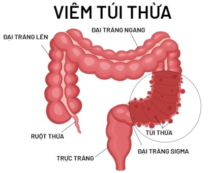 Biến chứng xảy ra nếu bệnh túi thừa đại tràng không được điều trị kịp thời