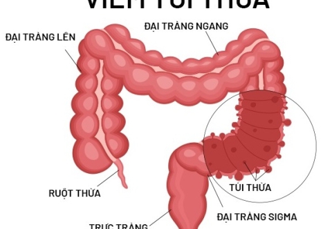 Biến chứng xảy ra nếu bệnh túi thừa đại tràng không được điều trị kịp thời