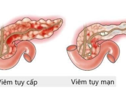 Viêm tụy mạn có gây ung thư tụy không, cách dự phòng viêm tụy mạn?