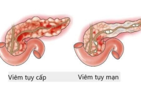 Viêm tụy mạn có gây ung thư tụy không, cách dự phòng viêm tụy mạn?
