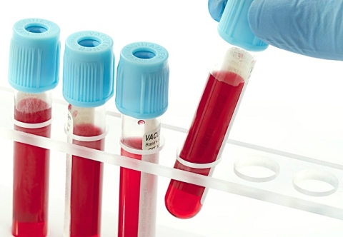 Cần làm gì khi nghi ngờ mắc ung thư dạ dày