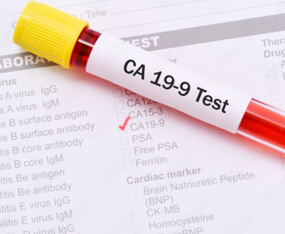 Dấu hiệu cảnh báo ung thư tụy