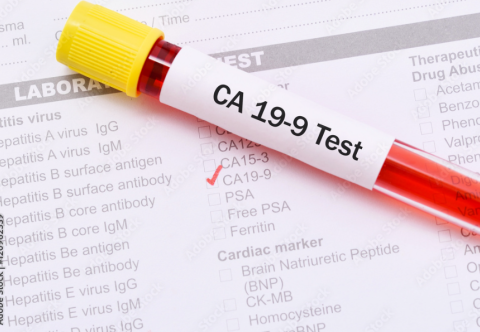 Dấu hiệu cảnh báo ung thư tụy