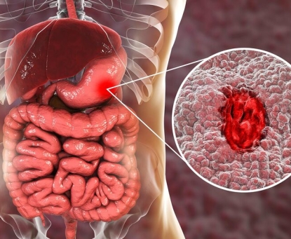 Dấu hiệu cảnh báo sớm bệnh xuất huyết tiêu hóa