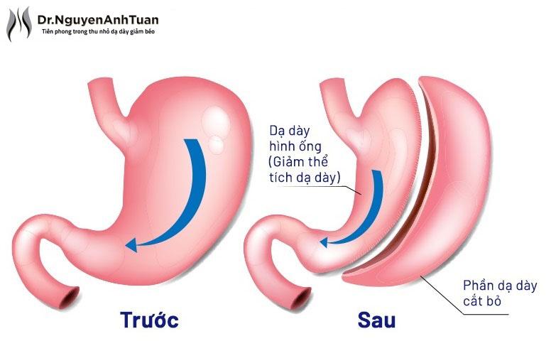 Cắt nhỏ dạ dày đang là phương pháp phẫu thuật giảm béo được nhiều người ưa chuộng 